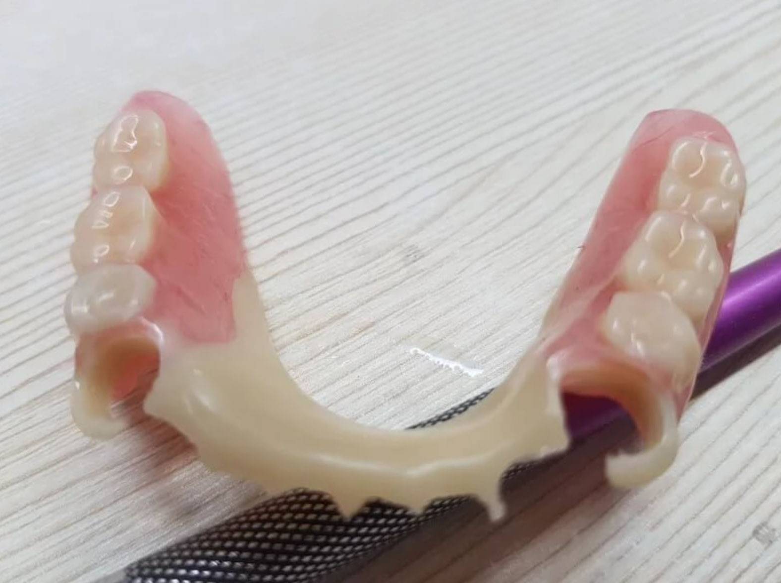 На фото: Акриловый протез. Съемное частичное протезирование