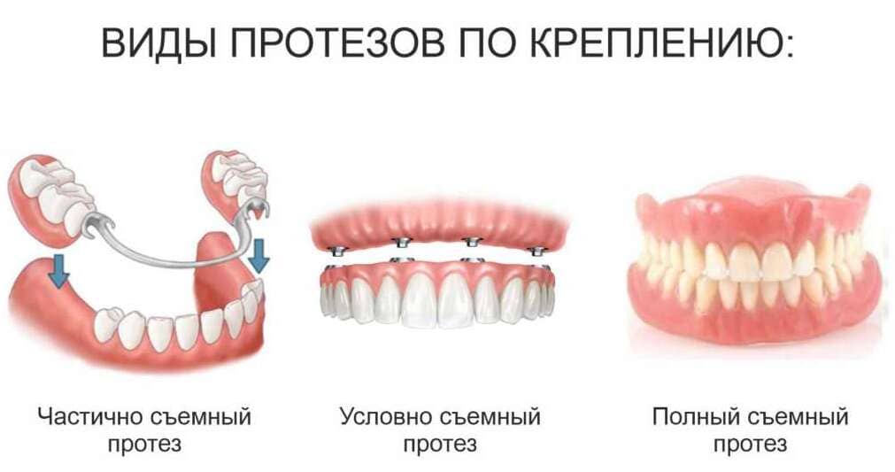 Виды протезирования